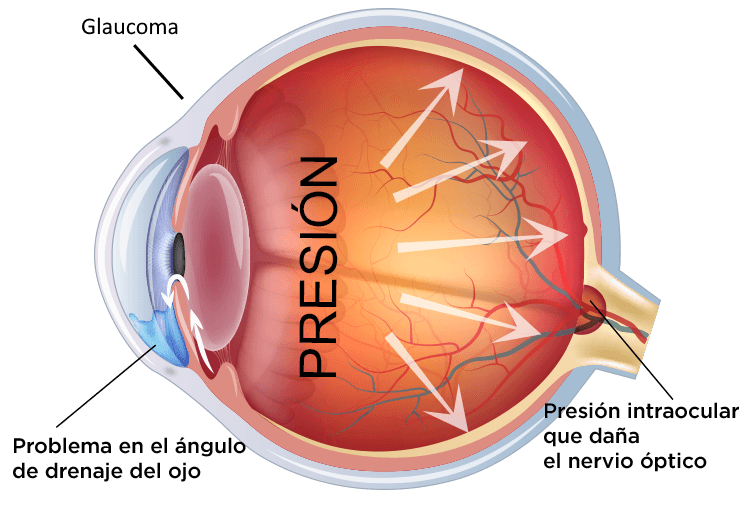 Cirugía de Glaucoma en Buenos Aires