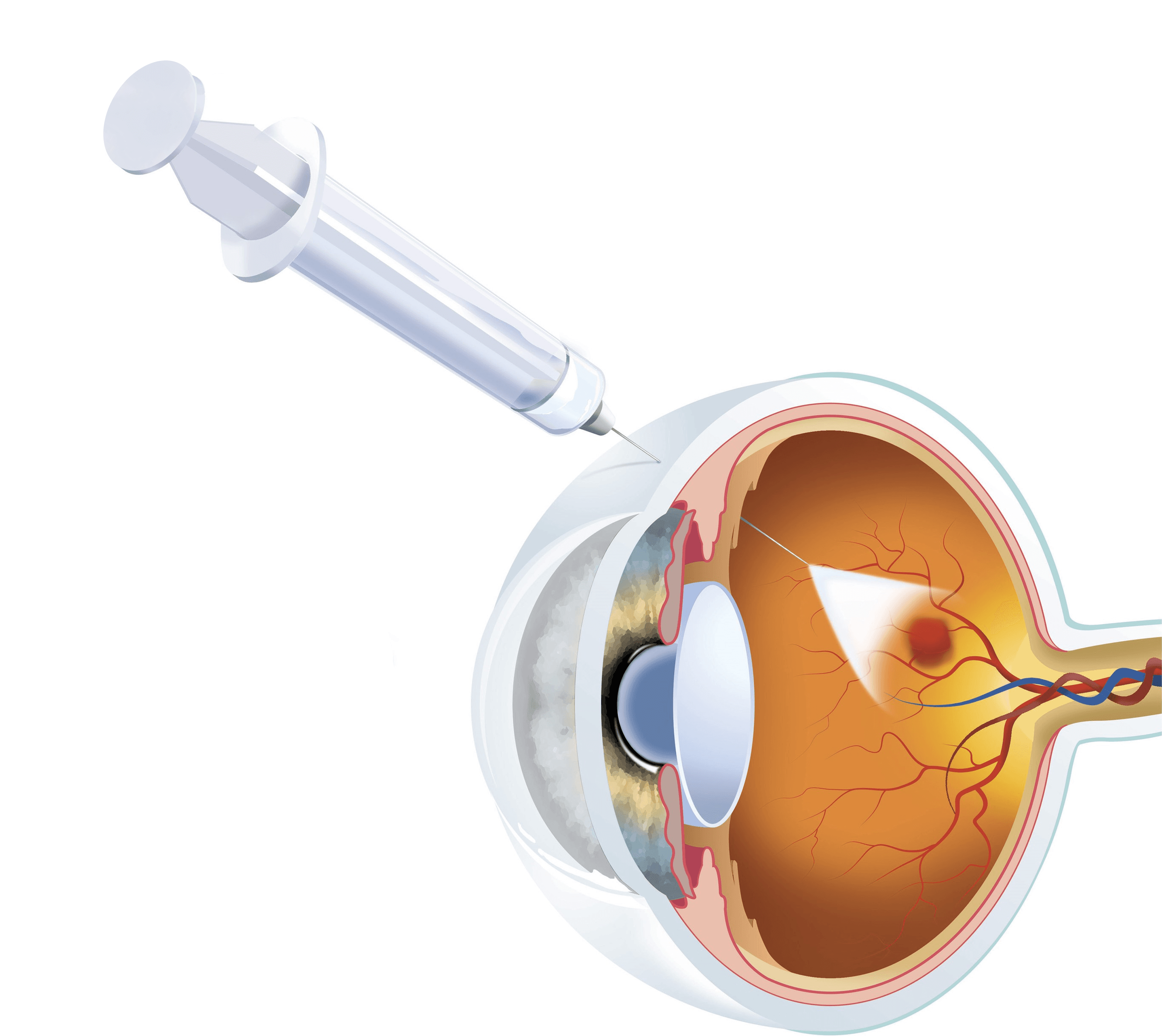Inyección Intravítrea en Buenos Aires