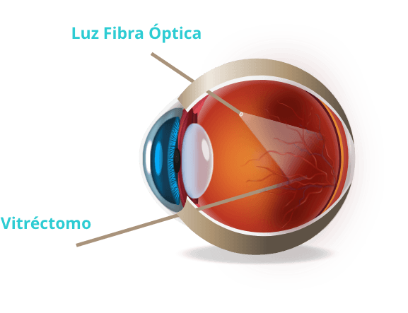 Vitrectomía en Ramos Mejía